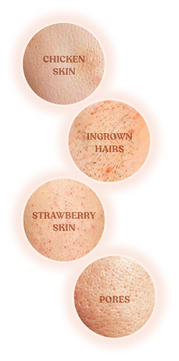 Skin concerns laser hair removal treats: chicken skin, ingrown hairs, strawberry skin, pores