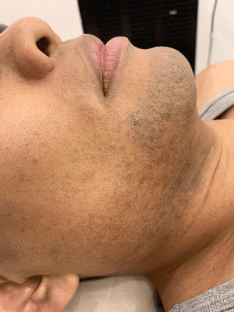 Bottom Face After 6 sessions