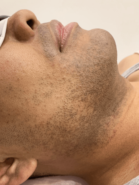 Bottom Face before treatment