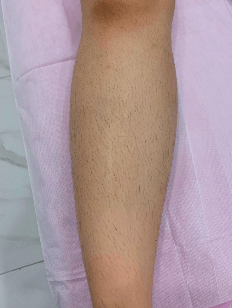 Lower Leg After 5 sessions