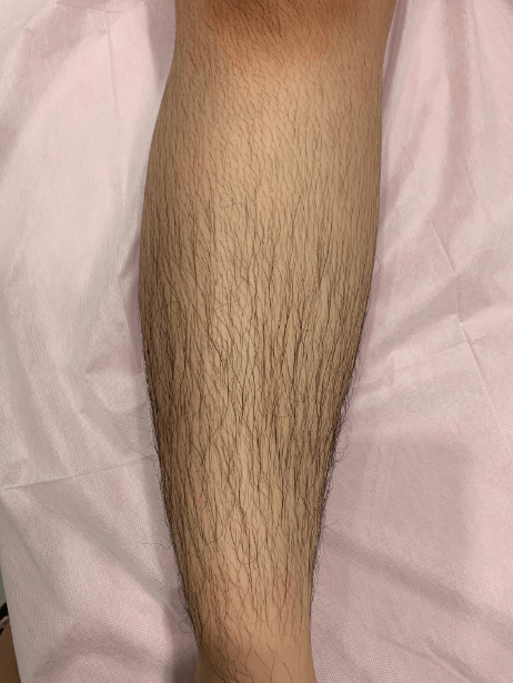 Lower Leg before treatment