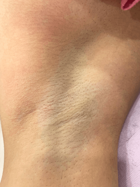 Underarm After 7 sessions