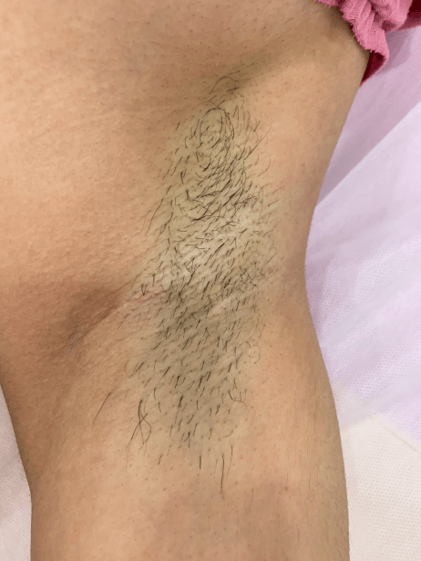 Underarm before treatment