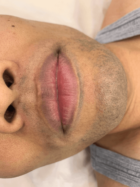 Bottom Face After 6 sessions