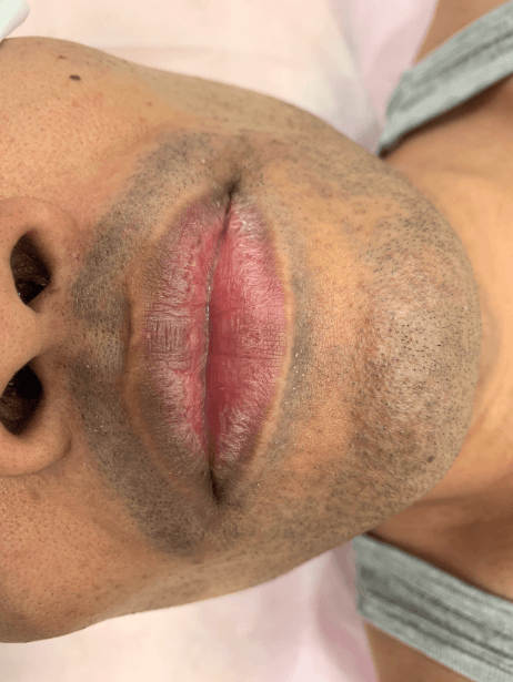 Bottom Face before treatment