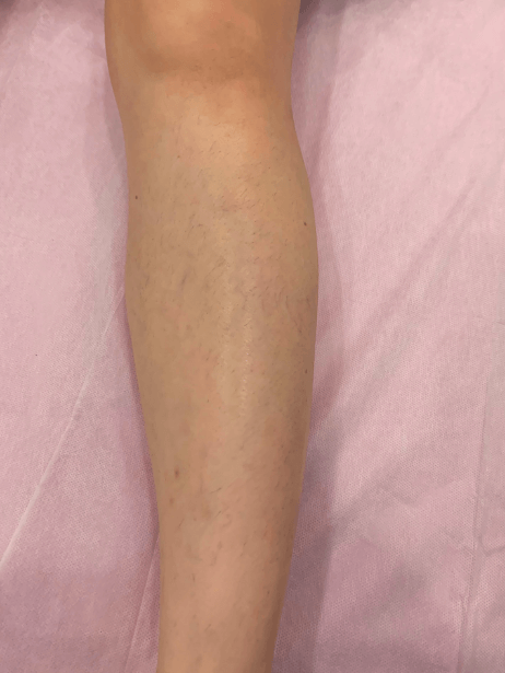 Lower Leg After 6 sessions