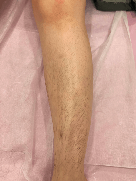 Lower Leg before treatment