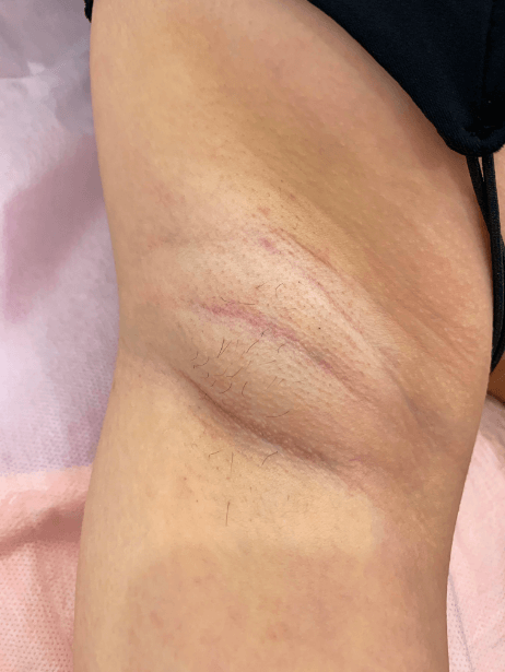 Underarm After 8 sessions