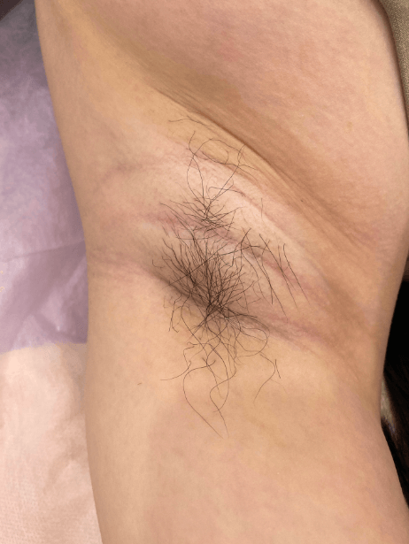 Underarm before treatment