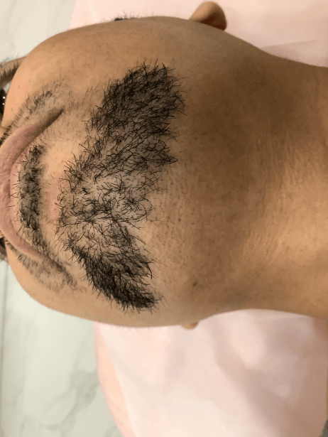 Bottom Face After 8 sessions