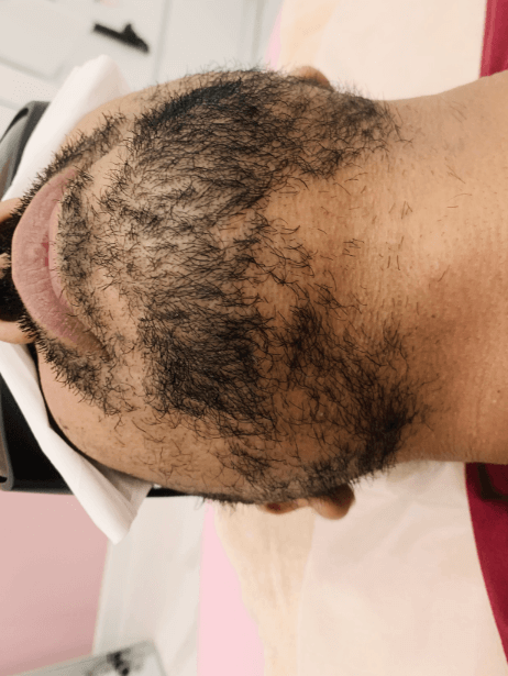 Bottom Face before treatment