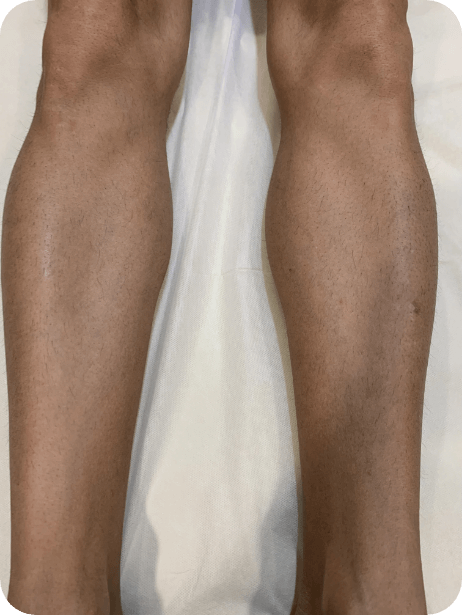 Lower Leg After 10 sessions