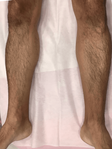 Lower Leg before treatment