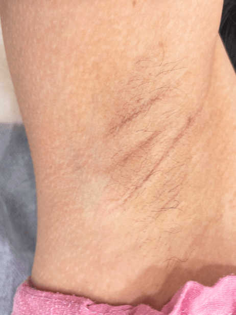 Underarm After 6 sessions