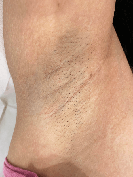 Underarm before treatment