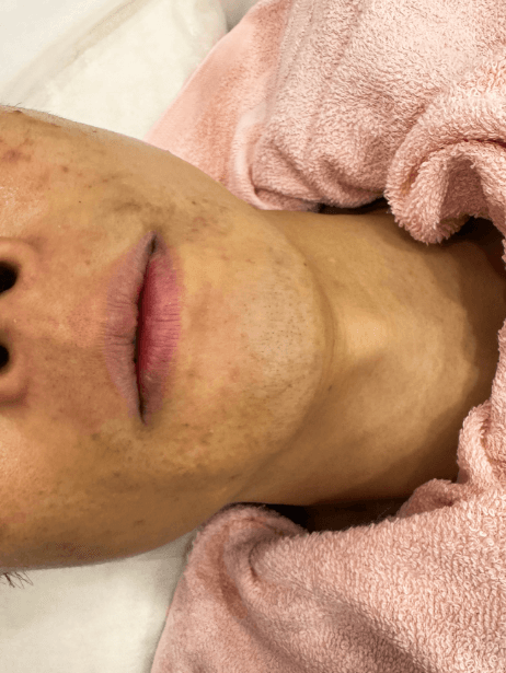Bottom Face After 8 sessions