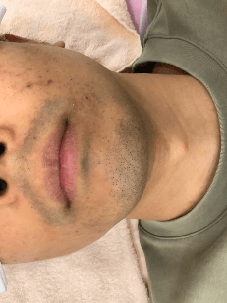 Bottom Face before treatment