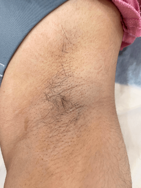 Underarm After 5 sessions