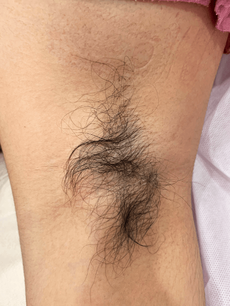 Underarm before treatment