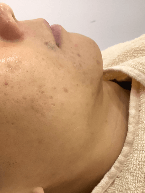 Bottom Face After 8 sessions