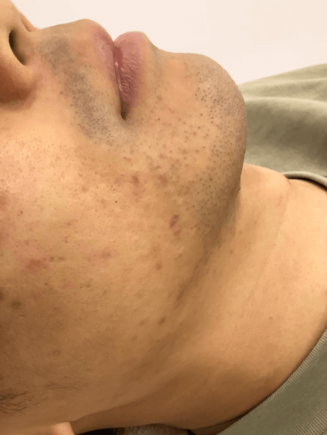 Bottom Face before treatment