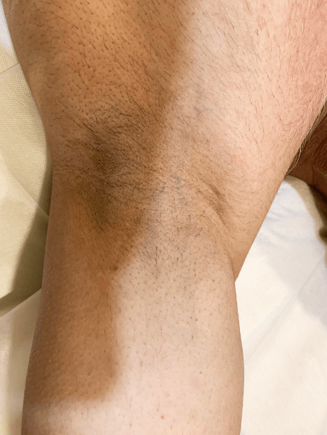 Underarm After 8 sessions