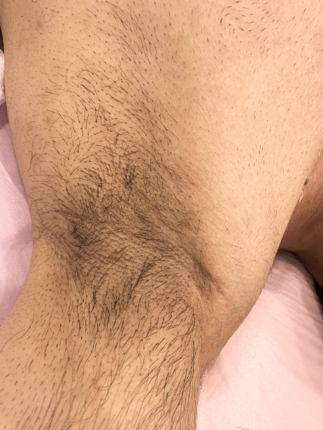 Underarm before treatment