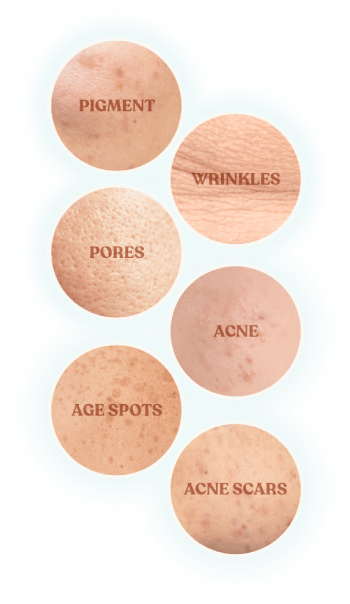 Common skin concerns Pico-Peels treats: pigment, wrinkles, pores, acne, age spots, acne scars