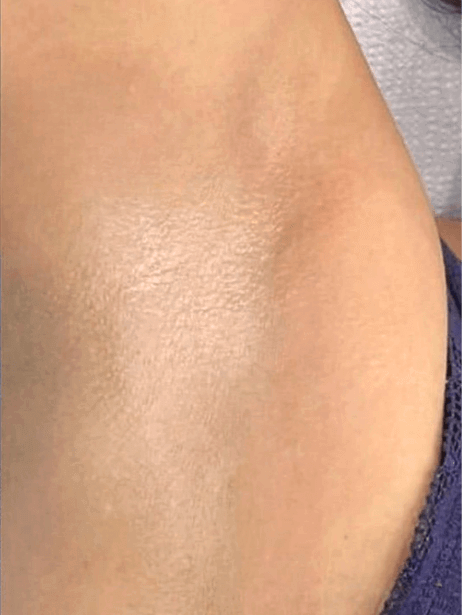 Underarm After 5–15 sessions