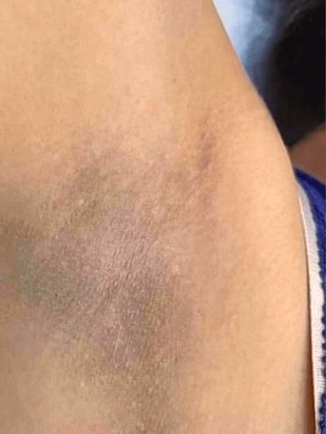 Underarm before treatment