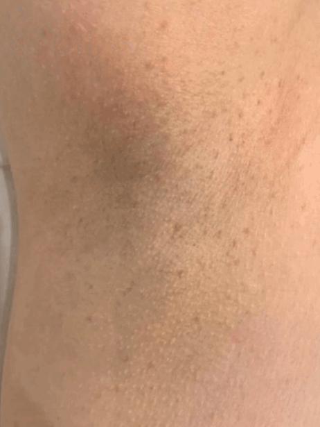 Underarm After 5–15 sessions