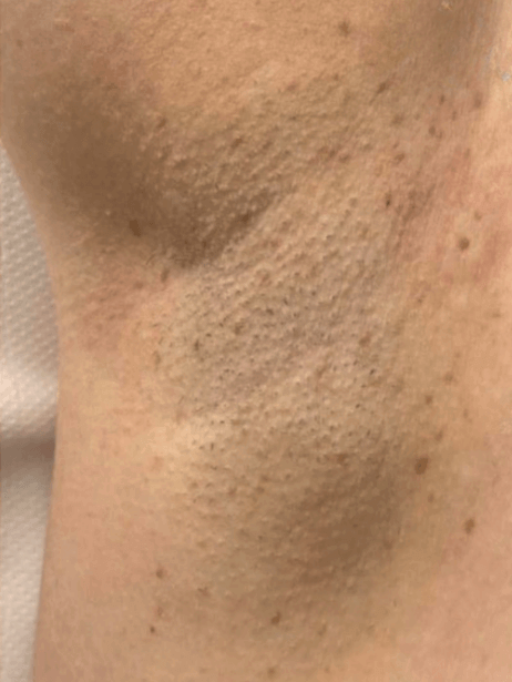 Underarm before treatment