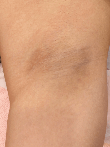 Underarm After 5–15 sessions