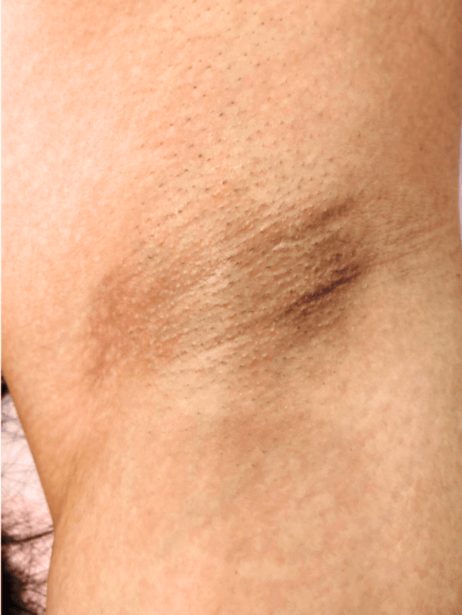 Underarm before treatment