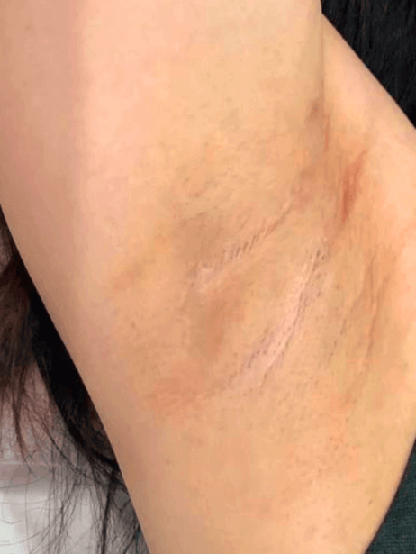 Underarm After 5–15 sessions