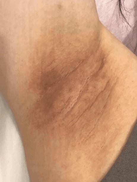 Underarm before treatment