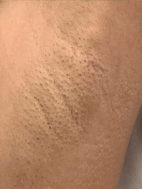 Underarm After 5–15 sessions