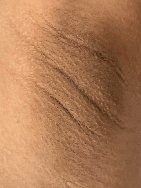 Underarm before treatment
