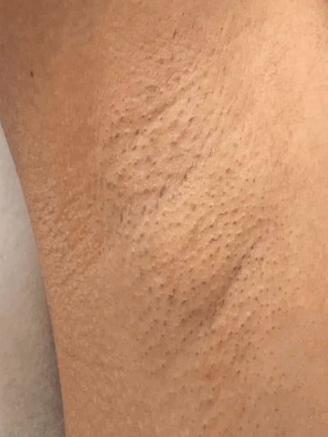 Underarm After 5–15 sessions