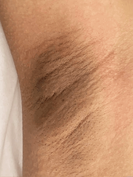 Underarm before treatment