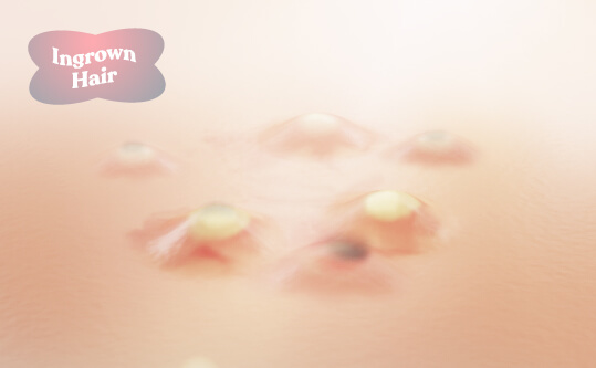 Facts: Ingrown Hair etc. Eww.