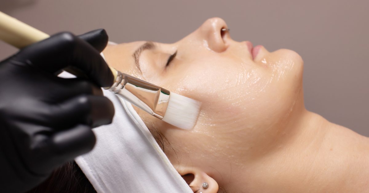 Chemical Peel Treatment | What to expect at Smooth Kitty