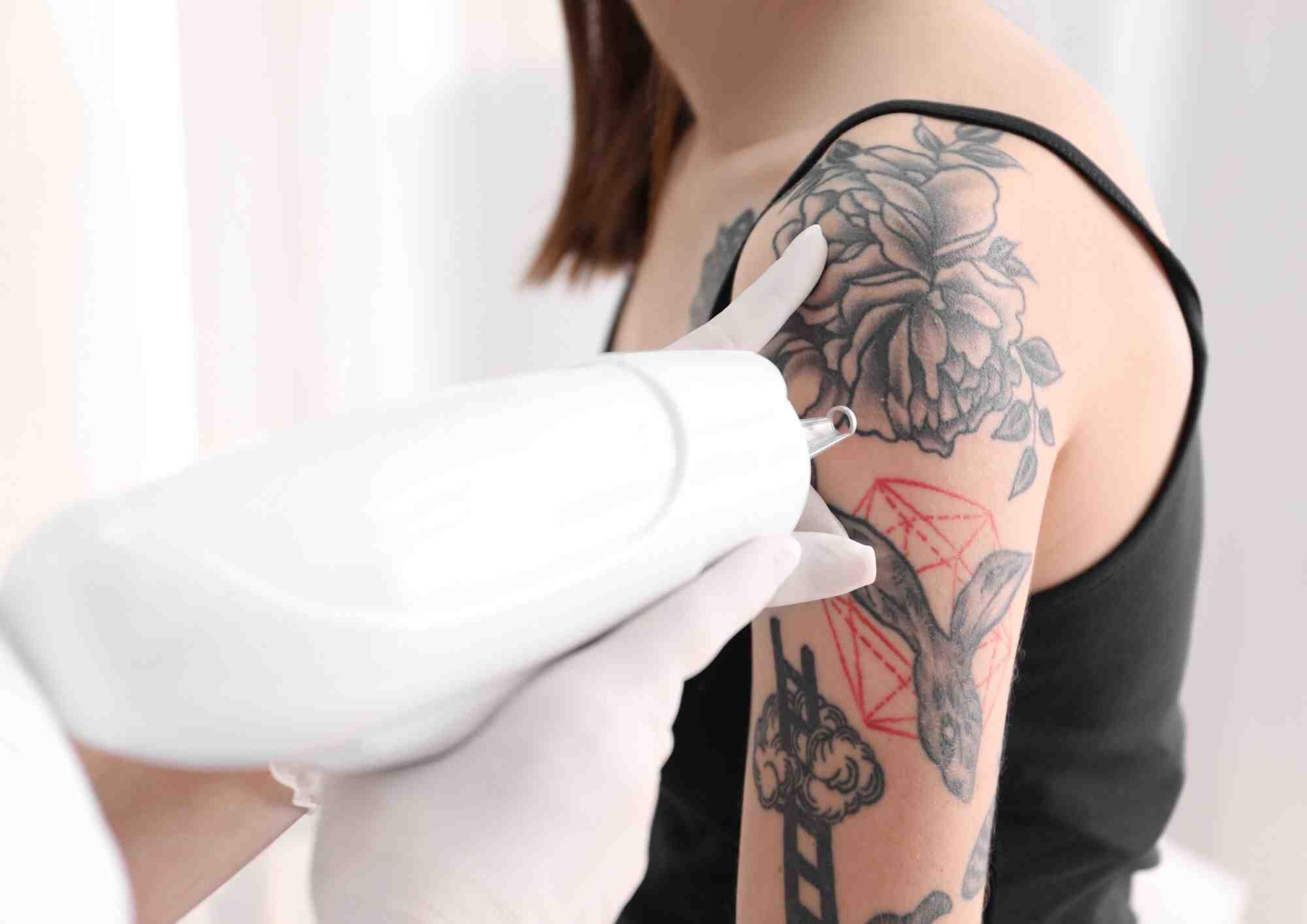 Why Pico Laser Near Me is Ideal for Tattoo Removal