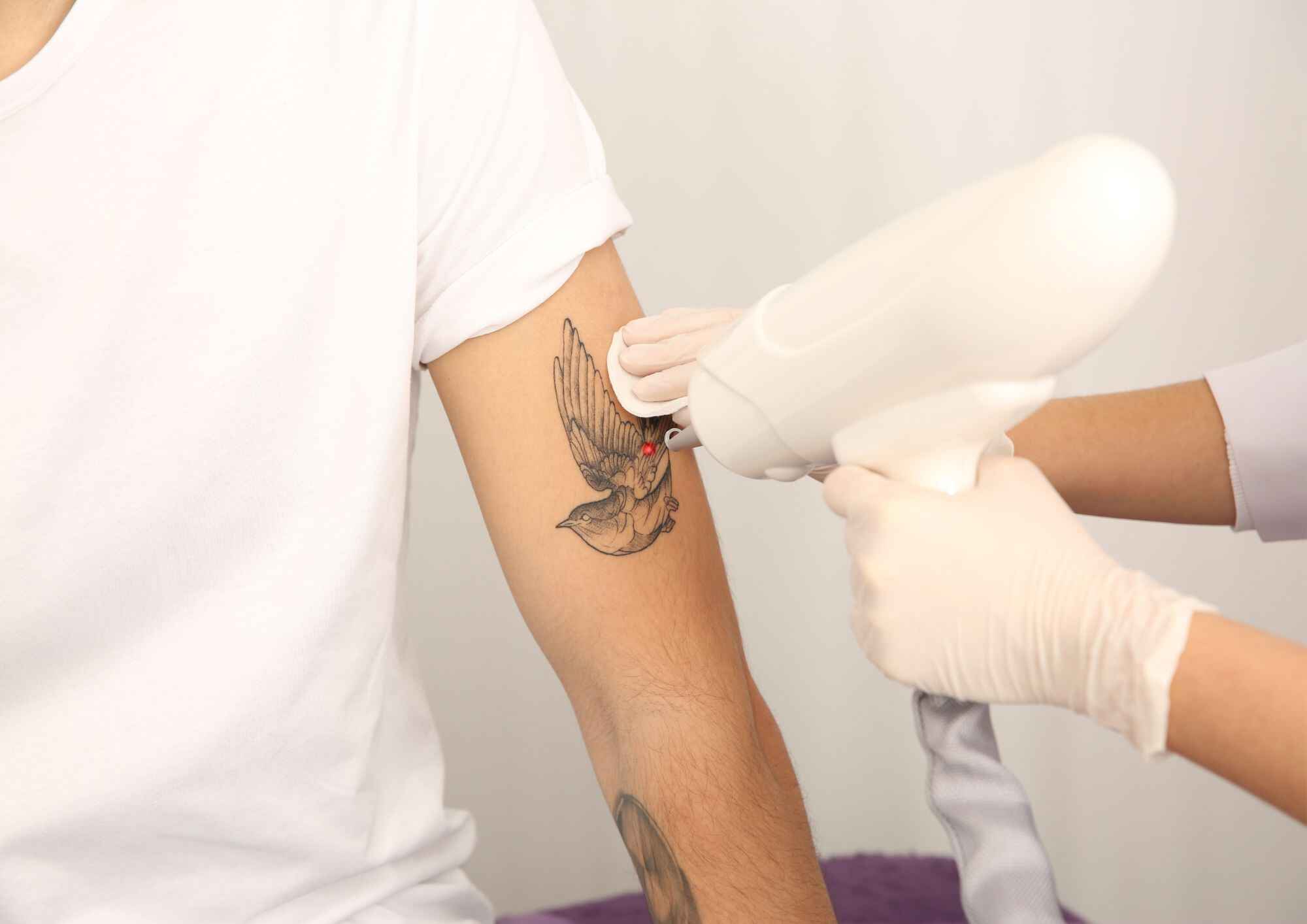 Why Pico Laser Is Revolutionizing Tattoo Removal