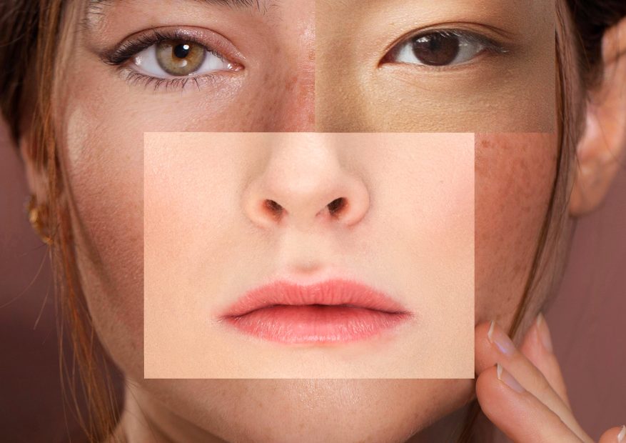Pico Laser for Freckles: Does It Work on All Skin Tones?
