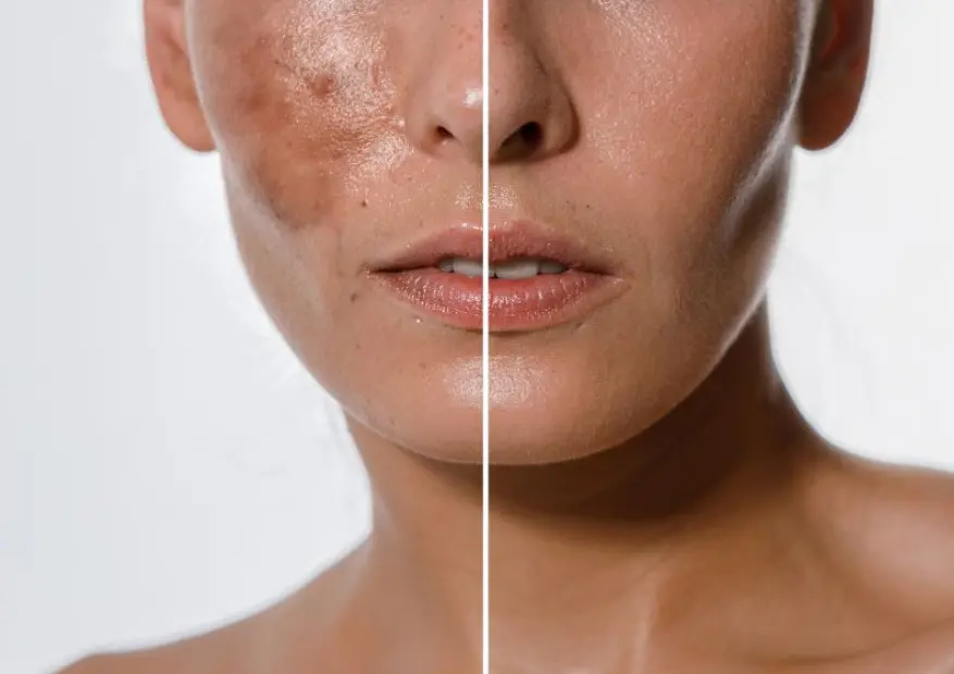 Can Chemical Peel Treatment Help with Sun-Damaged Skin?