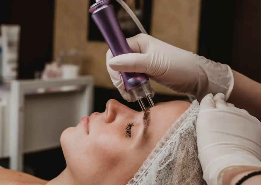 Pico Laser for Rosacea | Smooth Kitty Treatments