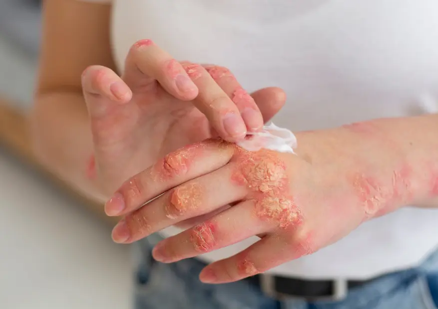 IPL vs Laser Hair Removal: Safe for Eczema & Psoriasis?