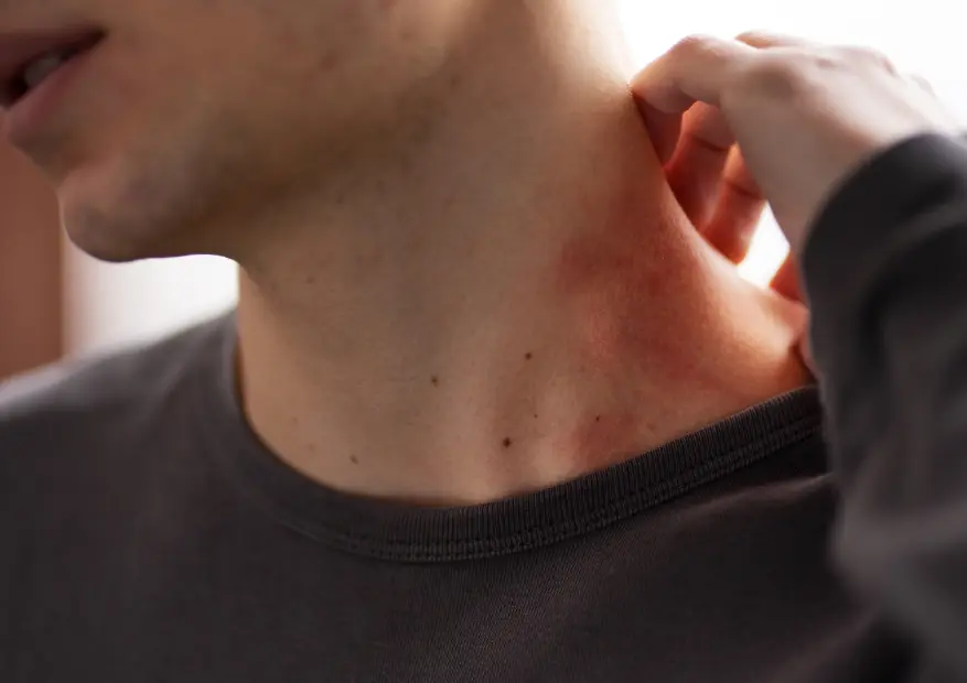 Can Pico Laser Help with Skin Redness and Capillaries?