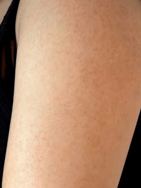 Arms & Legs After 5–15 sessions